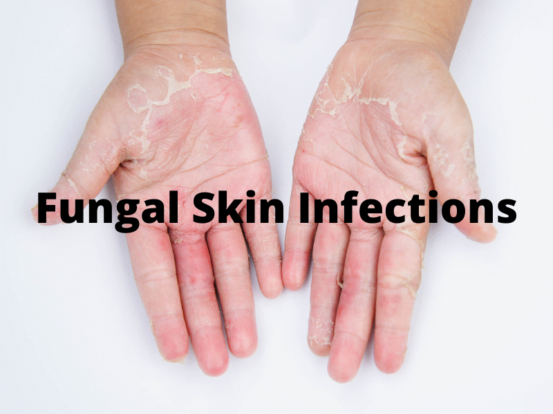 10 Natural Remedies for Fungal Skin infections